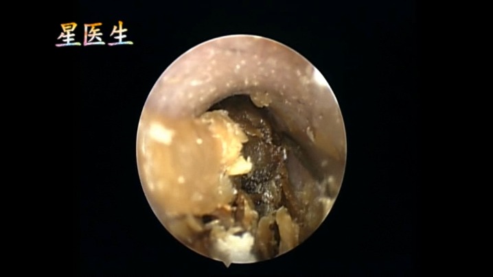 【星医生】高油分的陈年耵聍取出