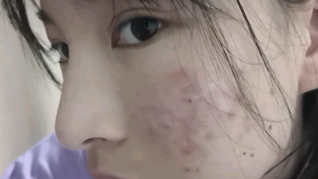 零零后记录痘龄四年77祛痘第一天自己针清