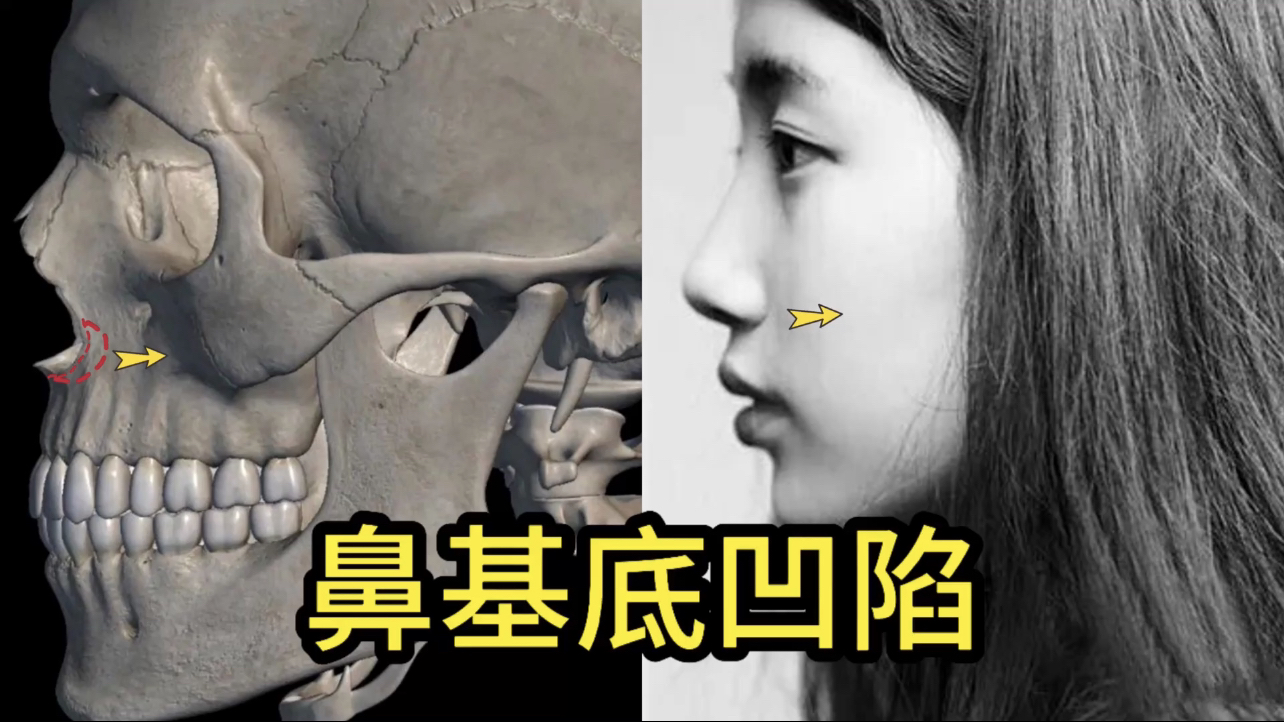 你也有鼻基底凹陷吗?教你自测!