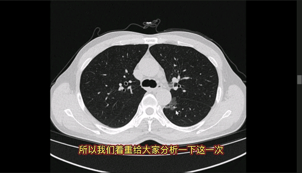 体检偶然发现肺磨玻璃结节:CT征象有哪些?动态图像分析讲解哔哩哔哩bilibili