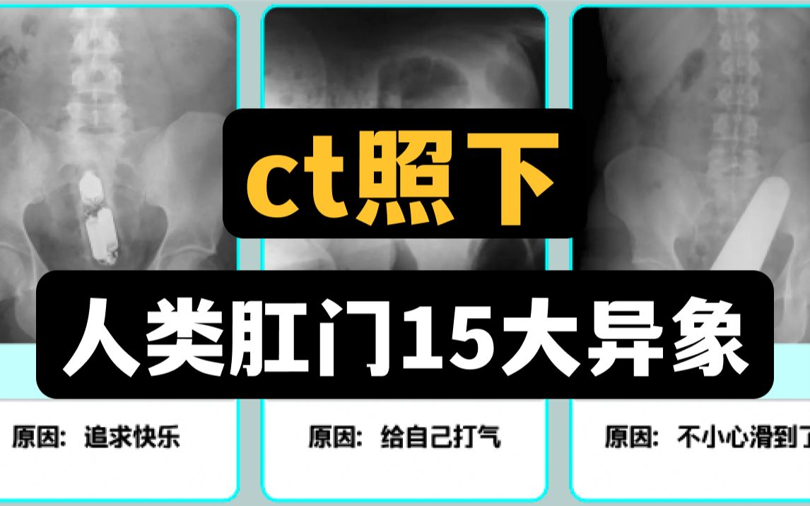 ct照下的人类肛门15大异象,大部分是男生哔哩哔哩bilibili