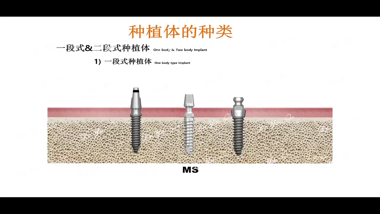 Osstem种植系统详解 撒悦哔哩哔哩bilibili