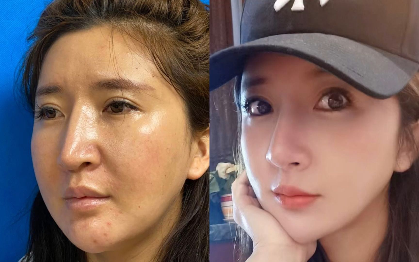 "一眼假"女巫鼻修复-广州张红艳医生