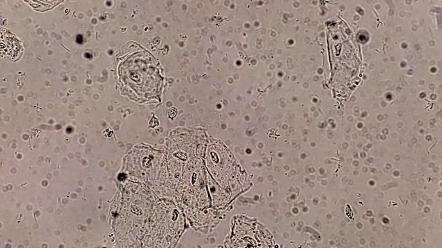 白带显微镜白细胞图片