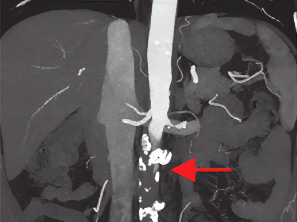 文献分享1 JAMA cardiology case report哔哩哔哩bilibili