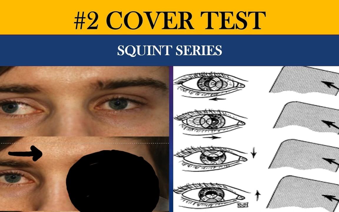 [图]COVER TESTS|Direct, Indirect, Cover-Uncover and Alternate cover - 眼科检查：遮盖试验