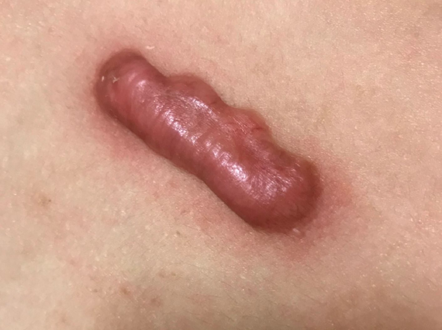 手术疤痕增生不用去做激光!过来人教你1个方法,在家淡化增生疤!