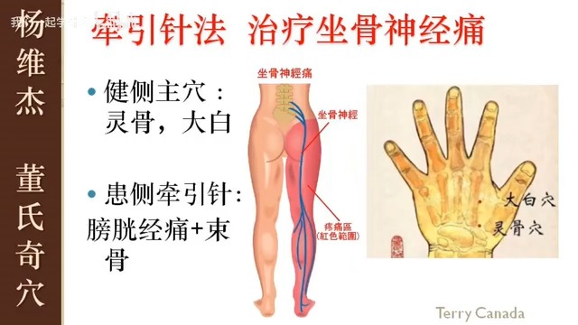【针灸】 牵引针法(董氏奇穴-杨维杰-60)