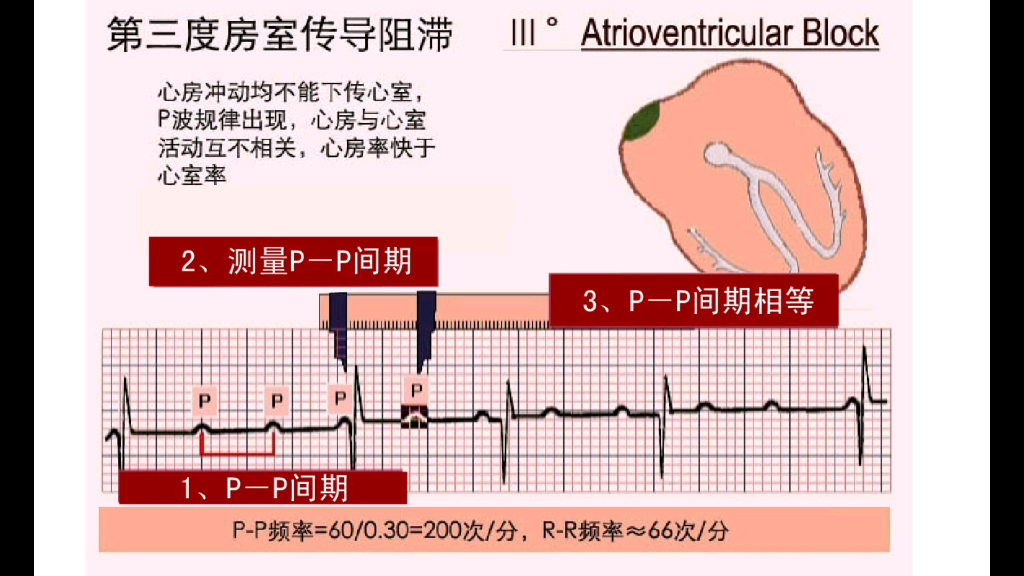 第三度房室传导阻滞AVB(中文)哔哩哔哩bilibili