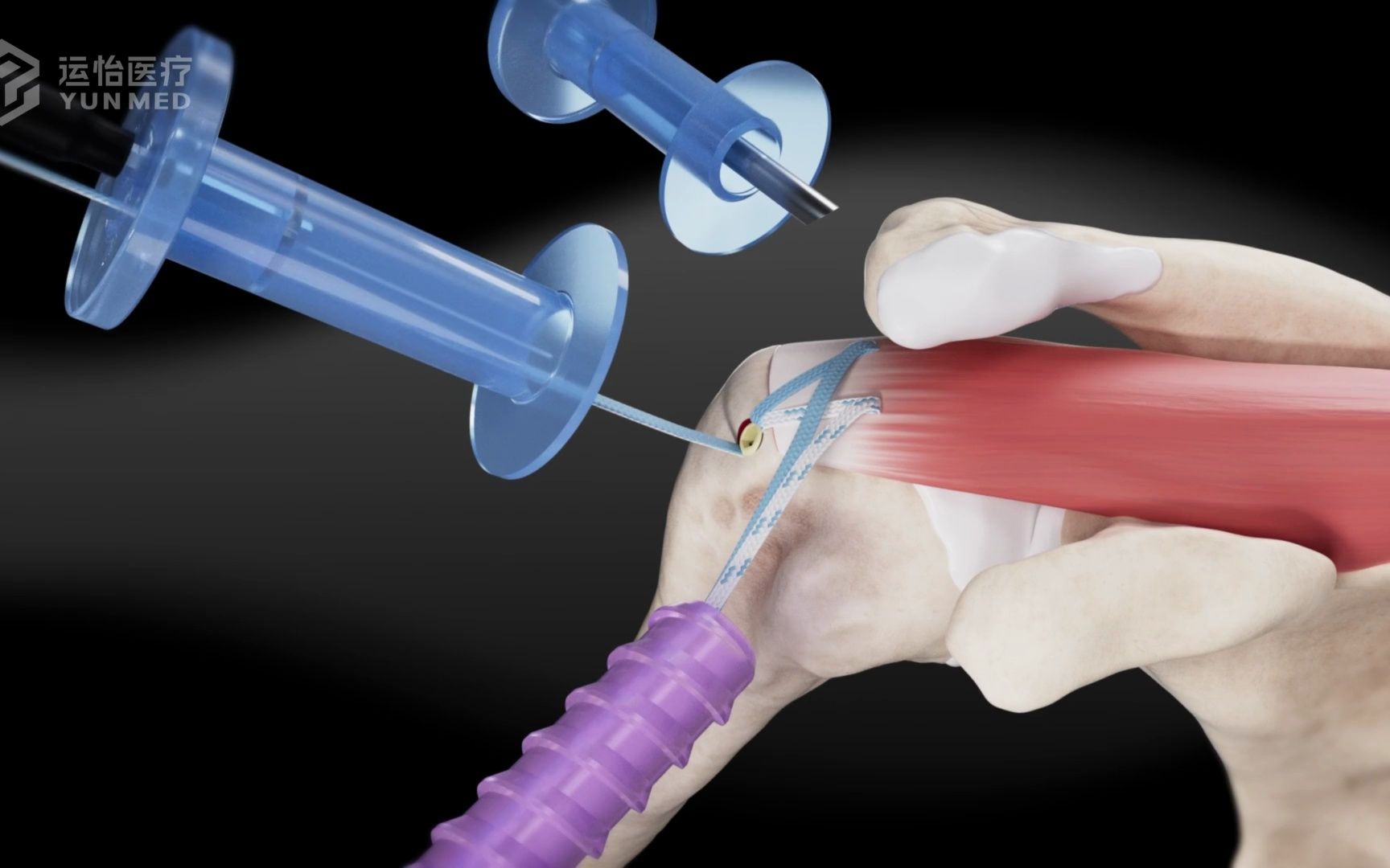 [图]【操作演示】肩袖撕裂修补快速缝线桥技术