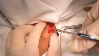 小刀拉屁股