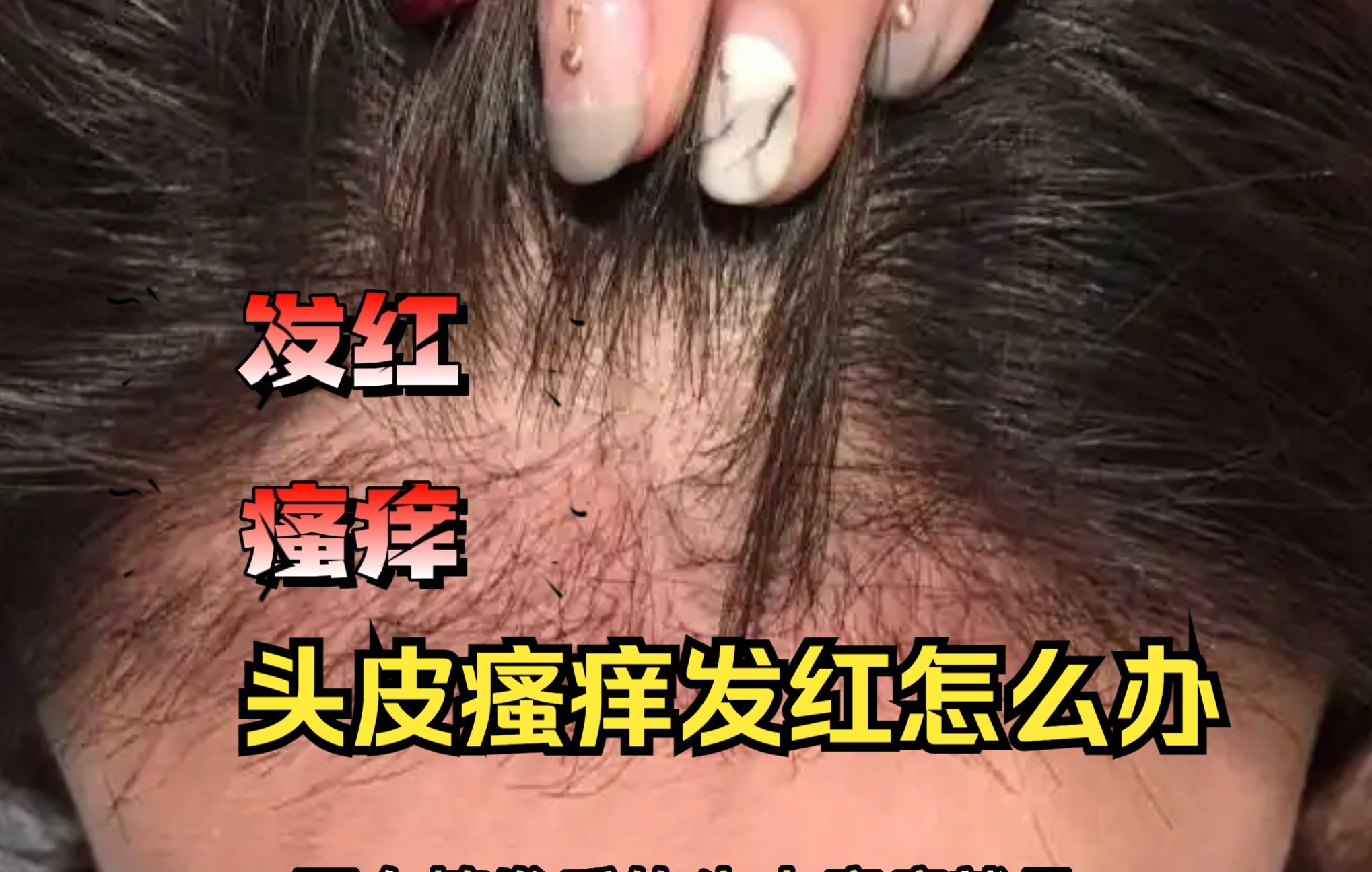 植发位置发红(植发位置发红怎么办)