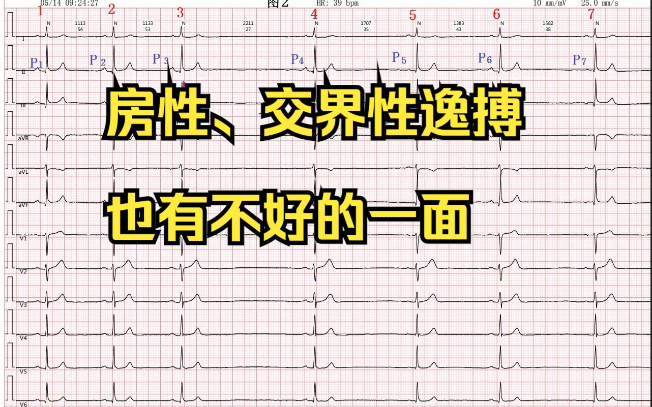 房性、交界性逸搏也有不好的一面哔哩哔哩bilibili