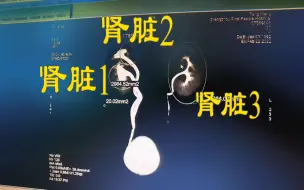 Tải video: 男子检查肾结石 意外发现自己有三个肾！