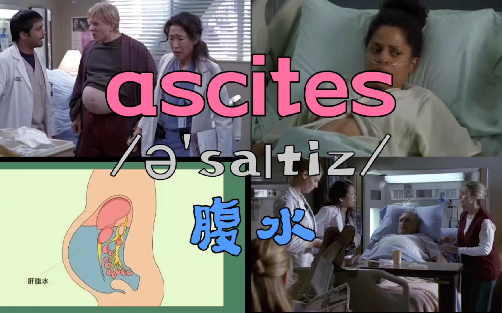 【医学词汇】ascites 腹水哔哩哔哩bilibili