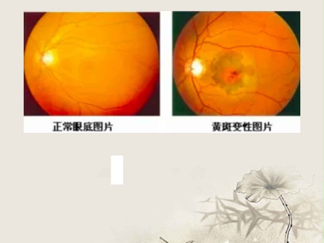黄斑病变又复发了 看看你是哪个原因
