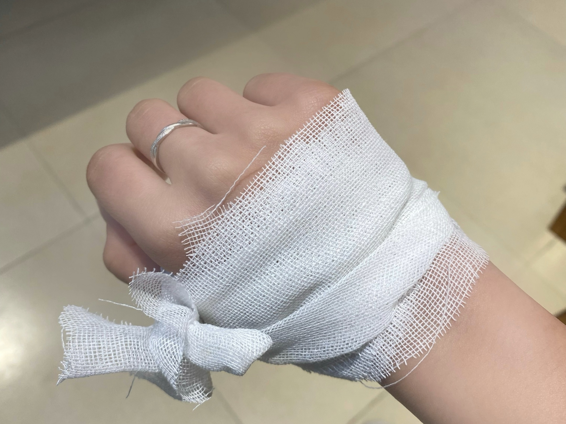 手烫伤了 这样包 帅炸了