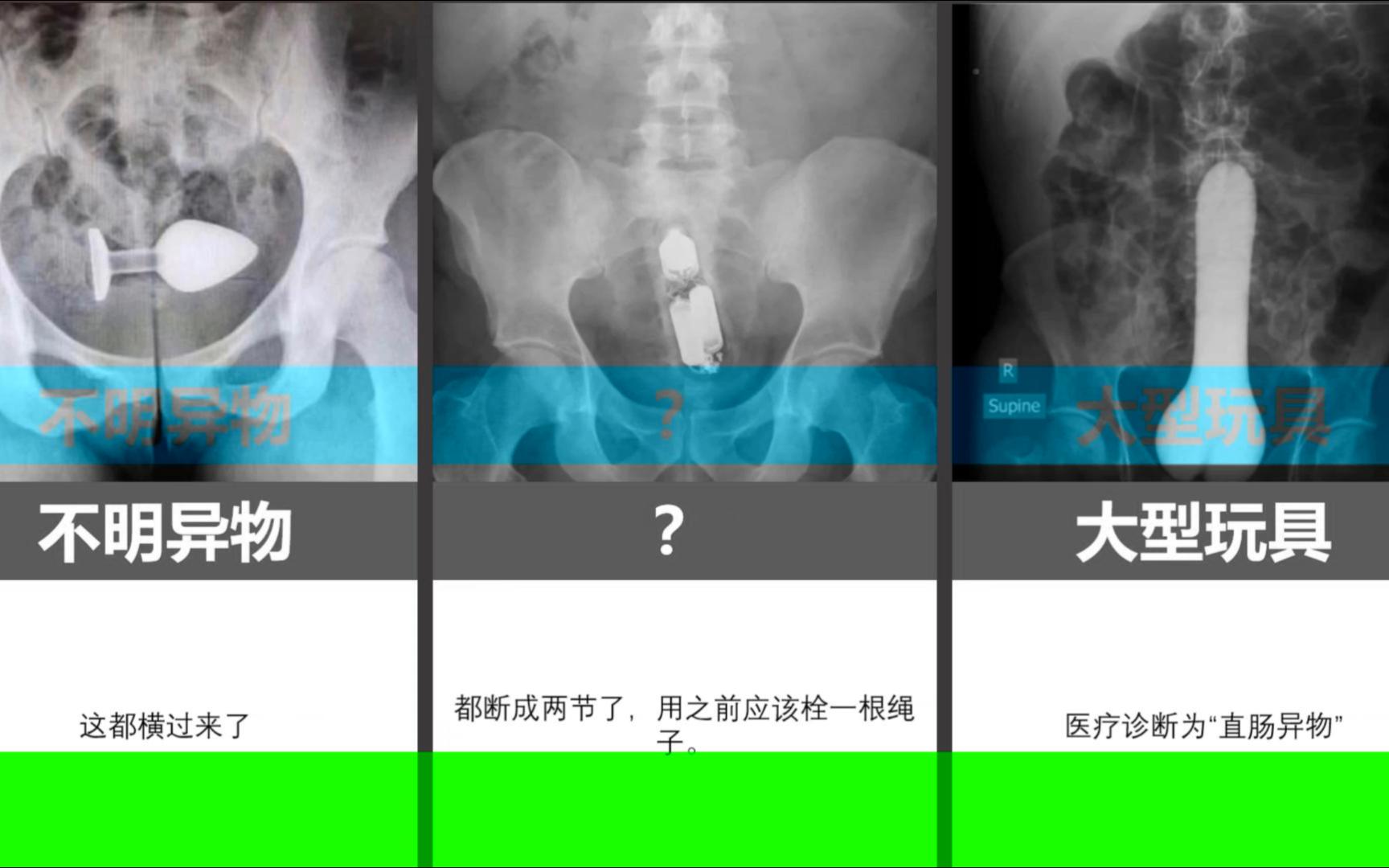 肛门异物怎么取出来图片