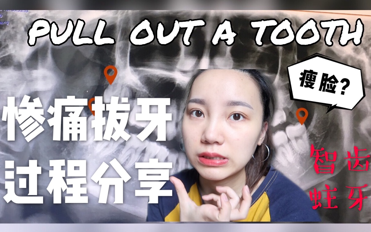 拔智齿Vlog | 拔牙真的能瘦脸?| 长蛀牙智齿怎么办 | 关爱牙齿健康、美好人生从“齿”开始 | 分享我的拔牙经历 | 智齿发炎疼痛难忍 | 搞笑生活记录哔哩哔哩...