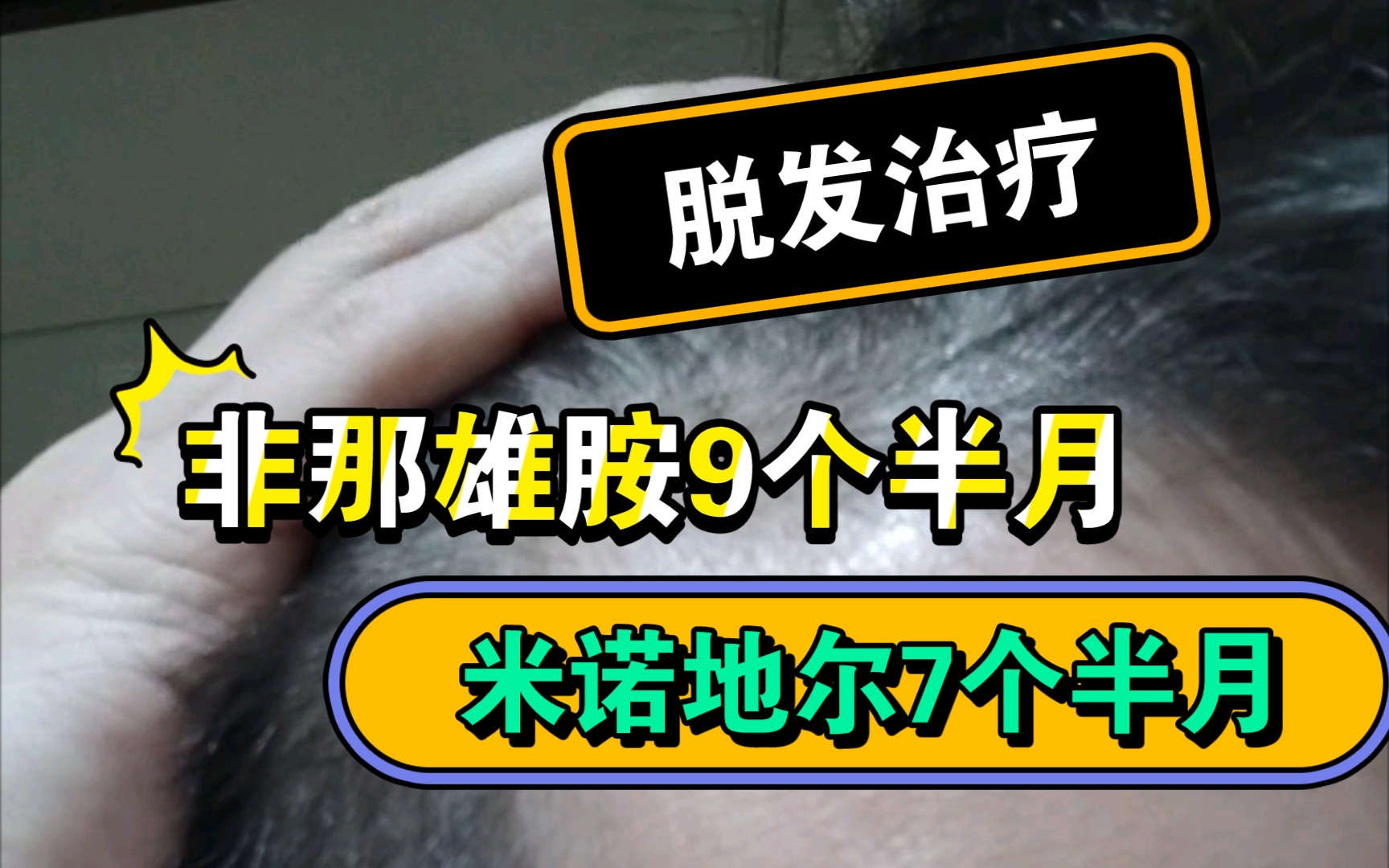 秃头怪治疗脱发,9个半月非那雄胺,7个半月米诺地尔反馈记录哔哩哔哩bilibili