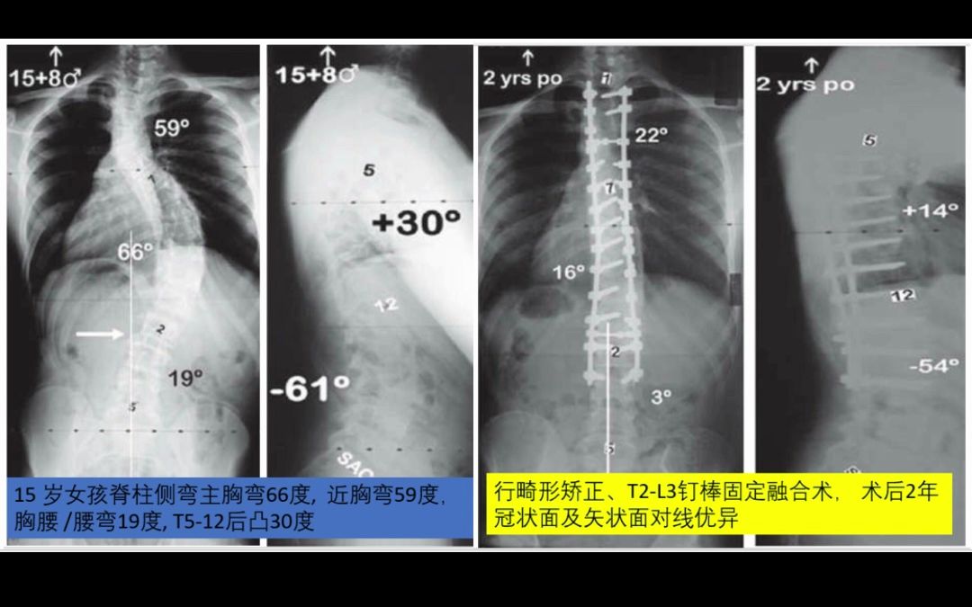 15 岁女孩脊柱侧弯主胸弯66度, 术后怎样了?哔哩哔哩bilibili