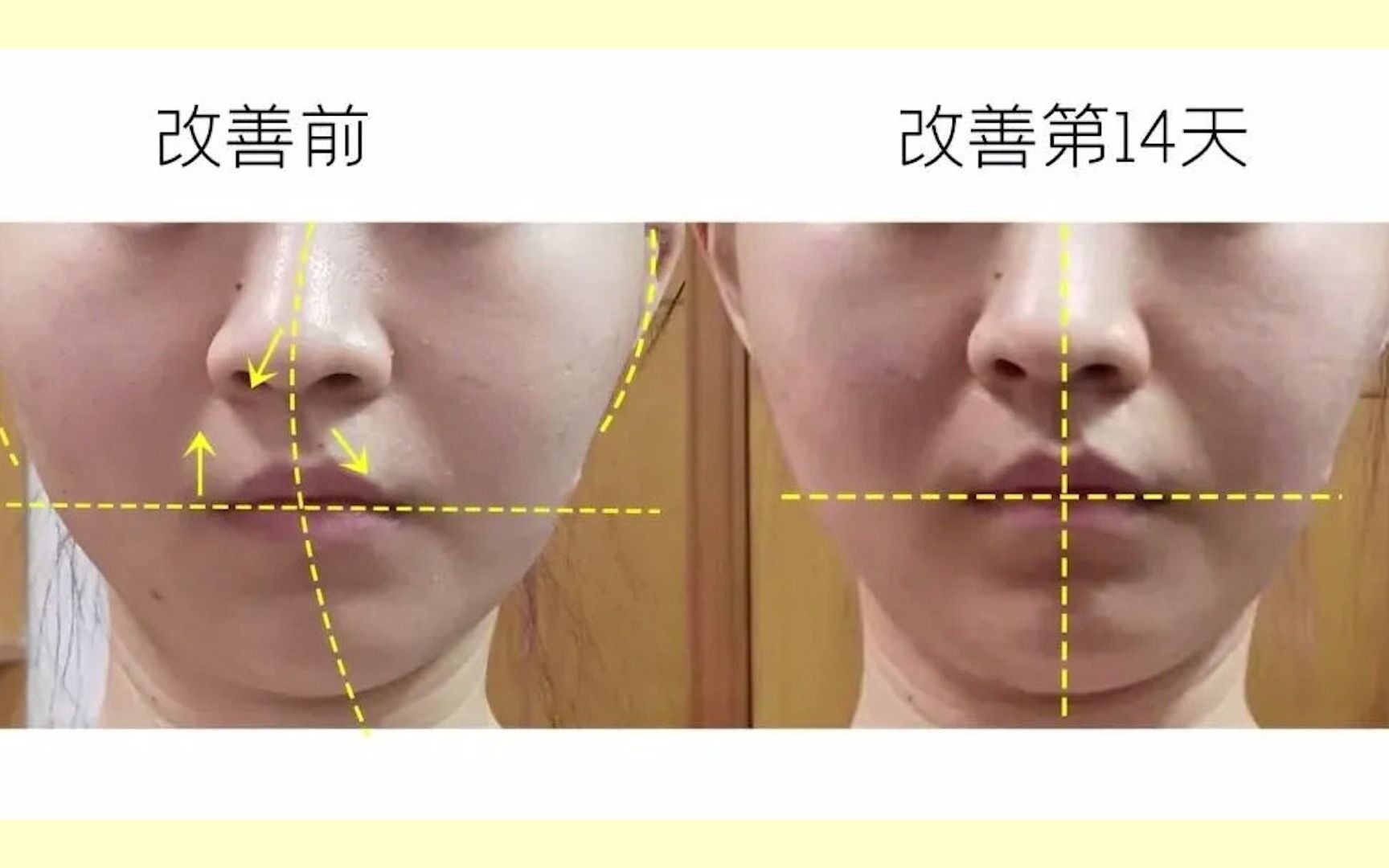 每日科普1分钟带你来了解大小脸鼻子歪斜如何矫正