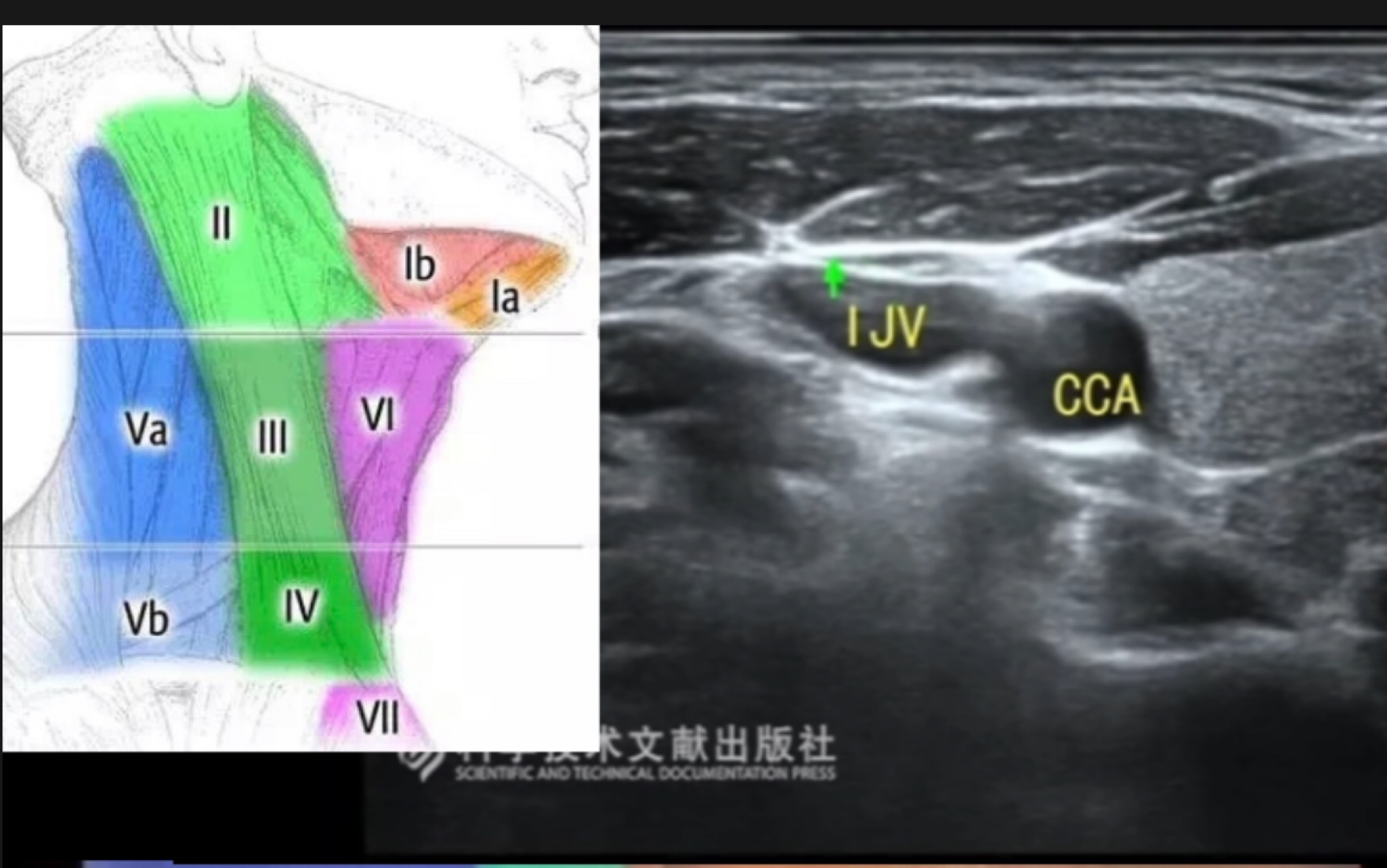 [图]超声颈部淋巴结分区