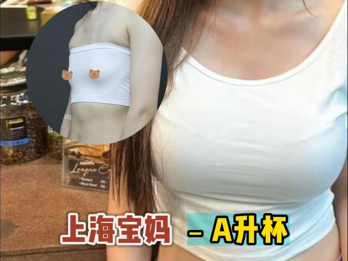 【李春财】上海宝妈 自体脂肪填充 负A成功升杯哔哩哔哩bilibili