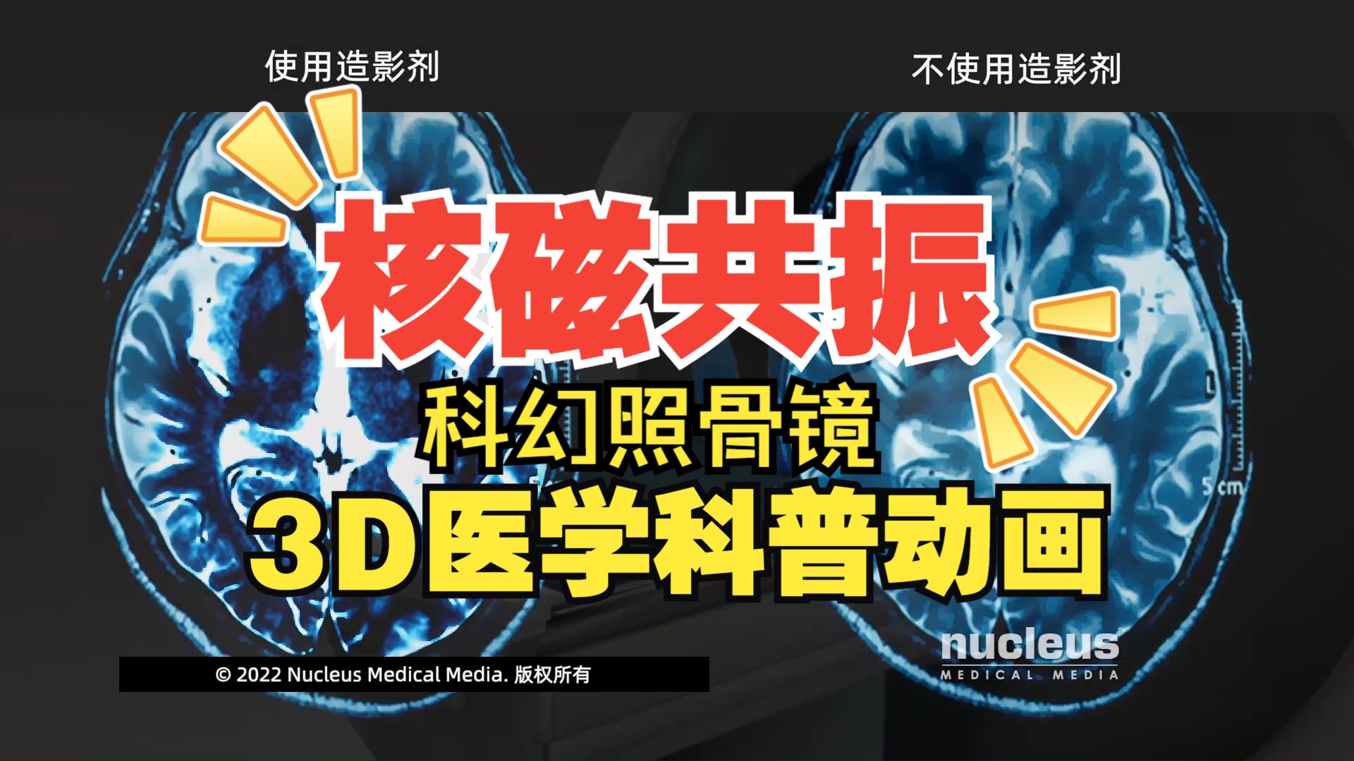 医学伟大发明系列:磁共振成像(MRI)3D科普动画(nucleus医学科普视频系列)中文哔哩哔哩bilibili