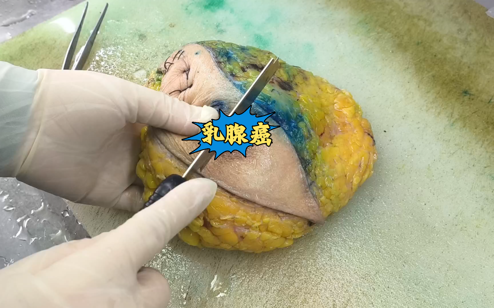 乳腺癌!乳腺癌作为女性高发且严重危及女性生命的癌症,具有以下特点:早期无症状,常无意中触摸到不可移动肿块,不疼不痒,建议女性四十岁后每年做...