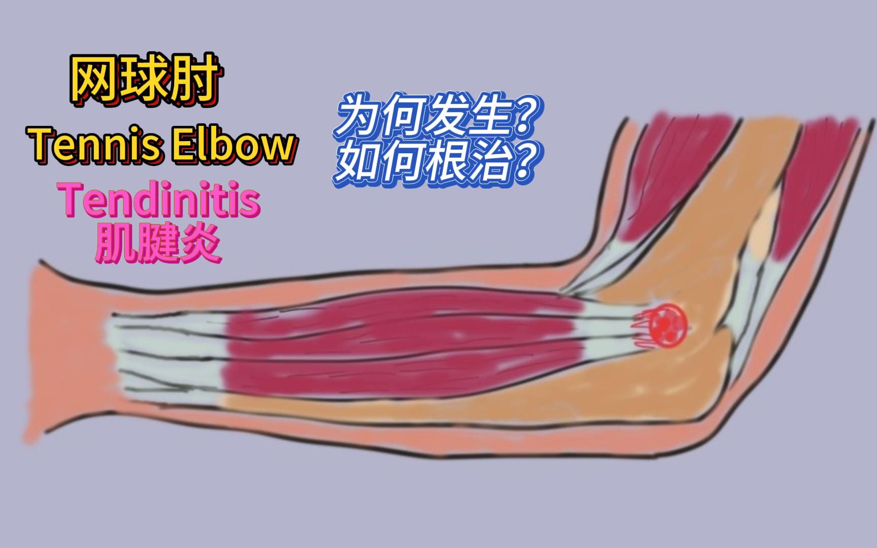 Tennis Elbow 网球肘, 肌腱炎, 介绍三个方法让你远离网球肘, 针灸, 推拿, 封闭, PRP, Tenex 手术哔哩哔哩bilibili