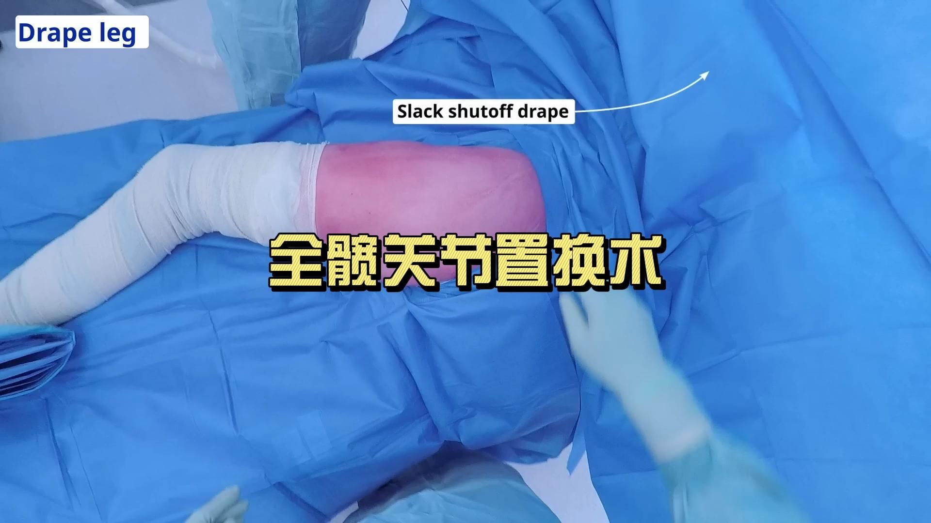 全髋关节置换术（后入路）国庆连更Day1（非医学相关专业慎入）