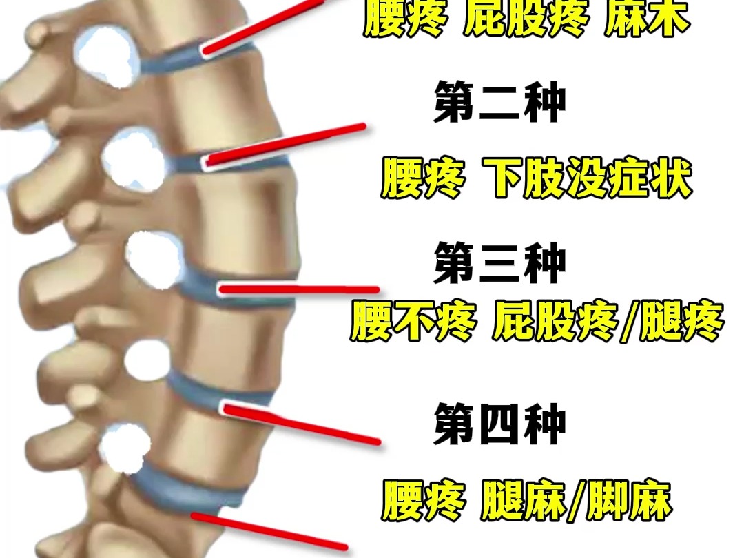 附桂骨痛腰椎间盘突出图片