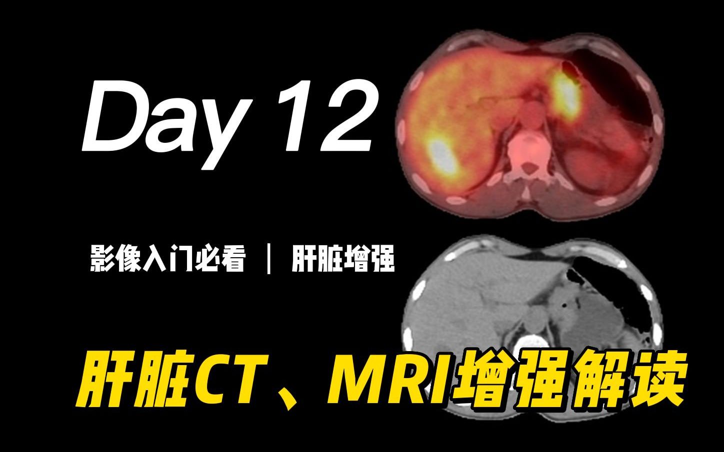 肝脏CT、MRI增强解读:时相准确性及其解剖生理基础 | 杨正汉教授讲解、动脉期、门脉期、平衡期、肝癌、供医学影像学、医学影像技术、临床医学专业人...