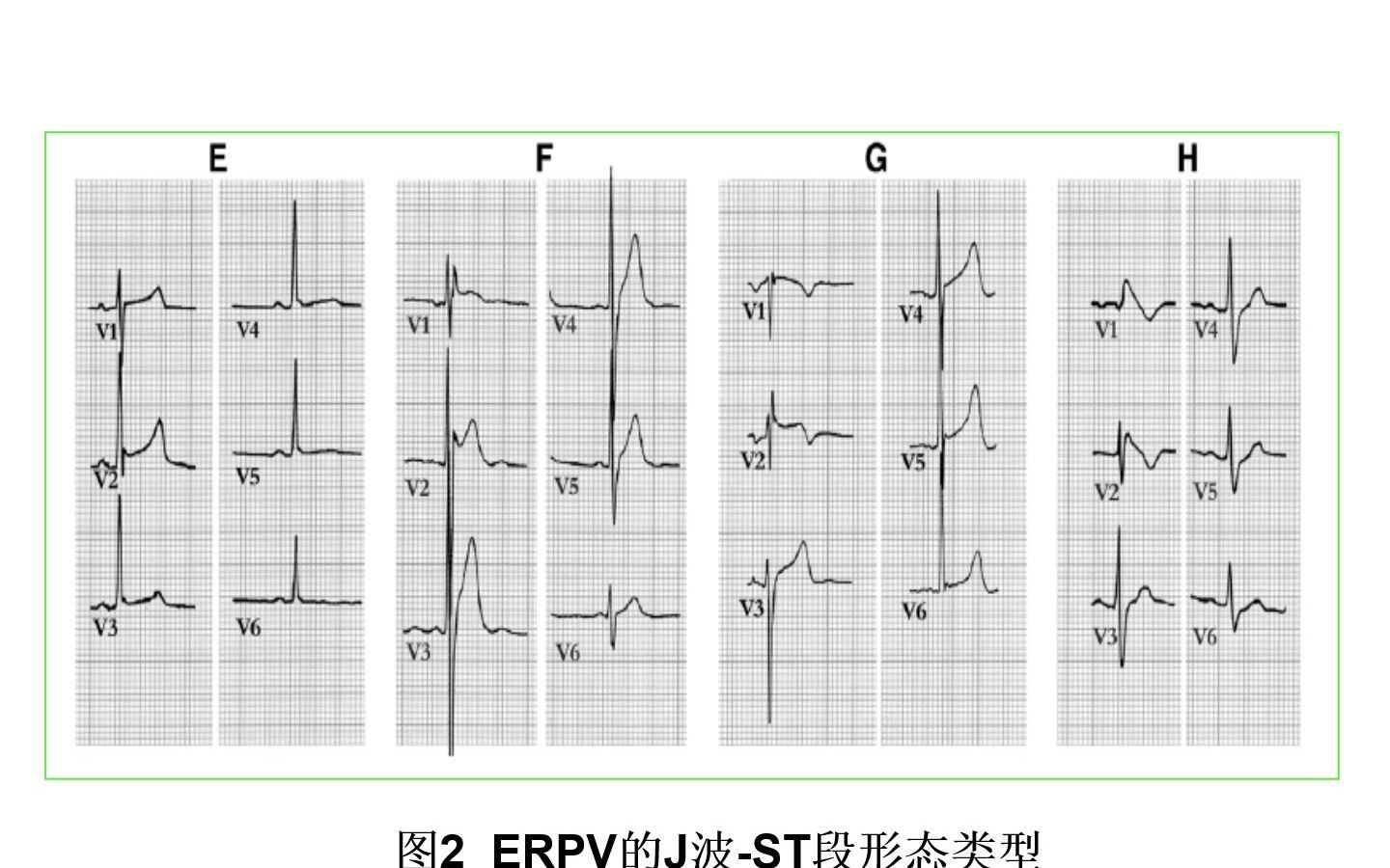 [图]临床常见心电图判读PPT