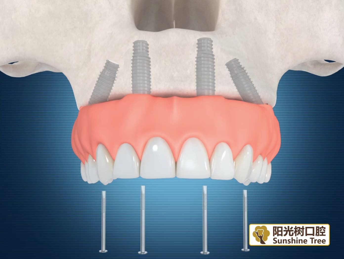 先进的种植牙技术,四颗螺丝是如何种好满口牙的?哔哩哔哩bilibili