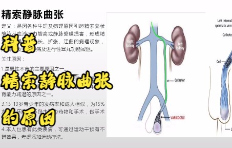 看文献总结精索静脉曲张哔哩哔哩bilibili