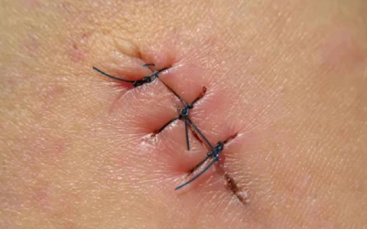 术后疤痕增生丑陋吓人?一涂一抹坚持30天,顽固老疤也能轻松淡化!