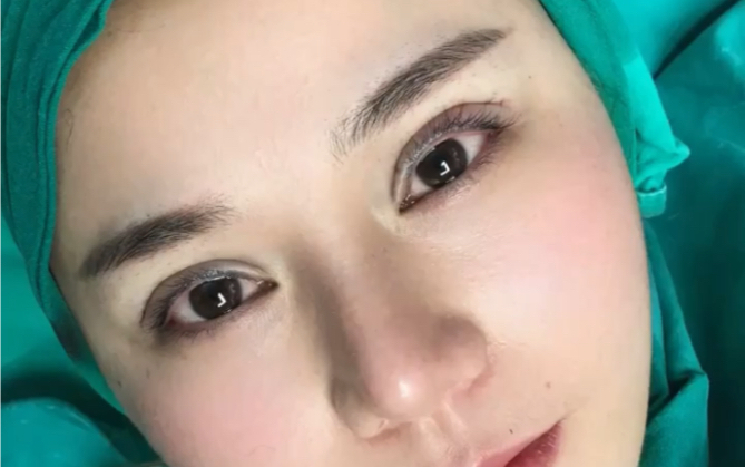 自然款双眼皮术后即刻,弧度自然,宛若天生,美丽明亮有神!