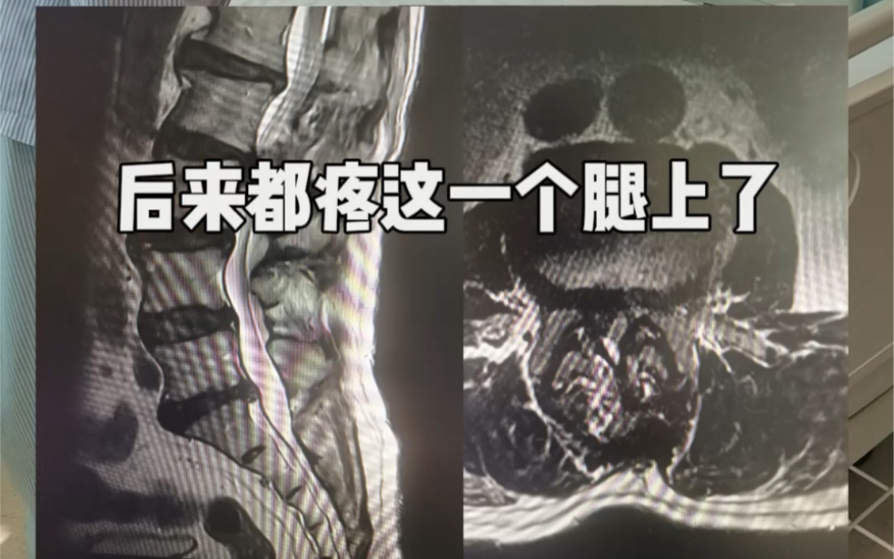 腰椎管狭窄#腰椎管狭窄#融合固定#椎间孔镜哔哩哔哩bilibili