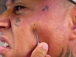 这钢化了的黑头，该怎么弄出来？
