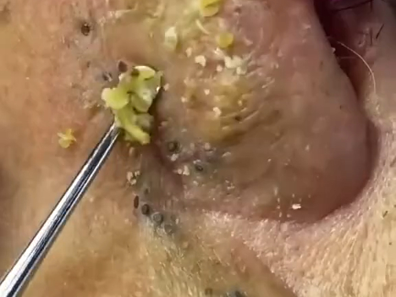 这满鼻子黑头,给小姐姐忙坏了