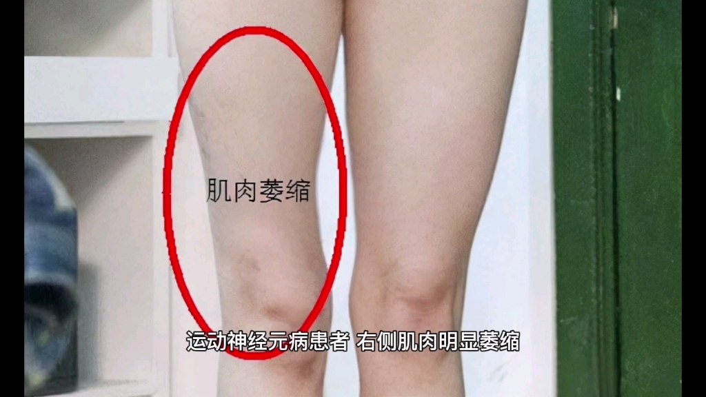 运动神经元,右侧大腿肌肉明显萎缩