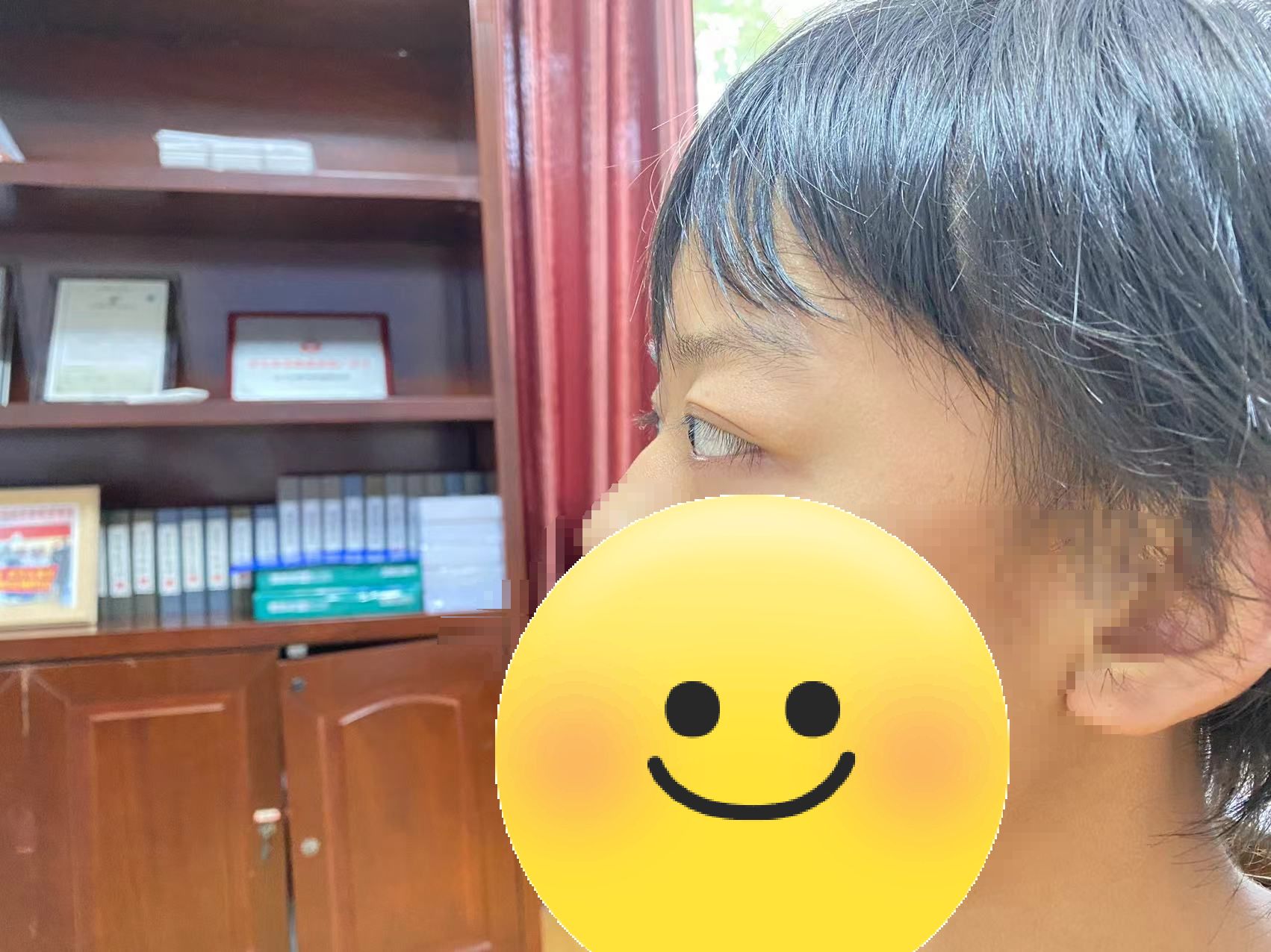 来自湖北荆门的孙同学患甲亢多年,眼球突出明显,双眼看起来比常人更大