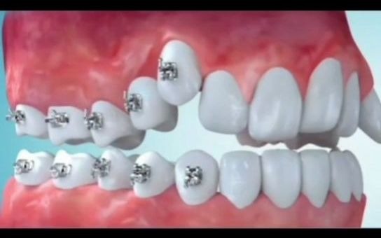 杭州西湖牙齿矫正:牙齿矫正的过程是怎样的哔哩哔哩bilibili