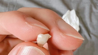 进来看我的后槽牙