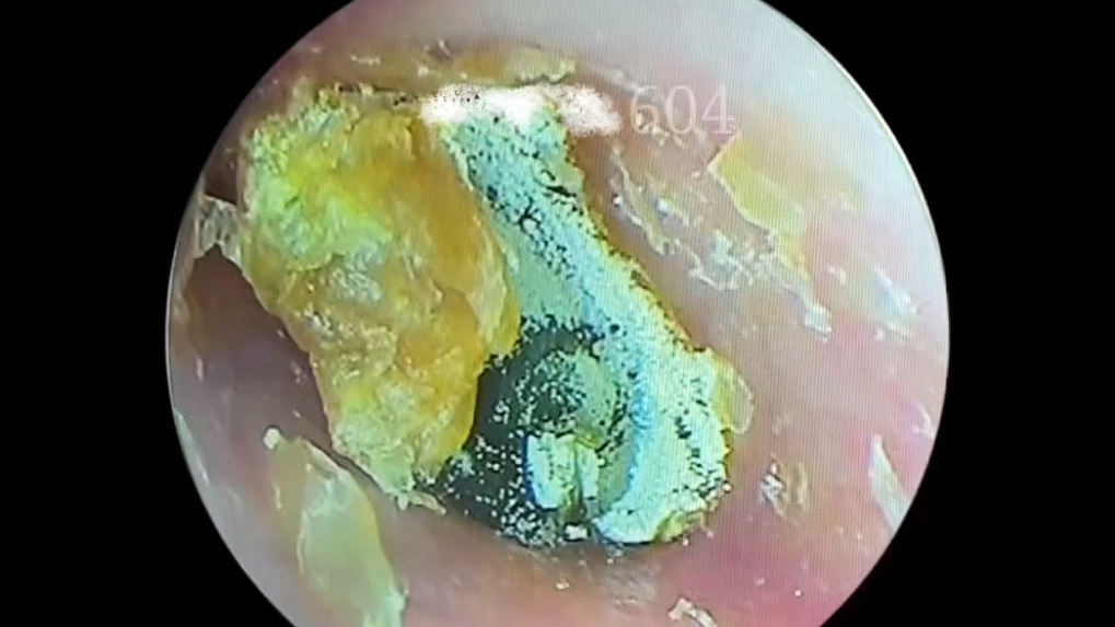 耳膜掏出来的图片图片