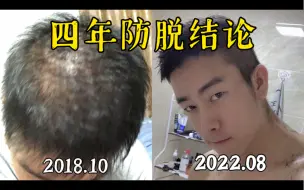 严重脱发经历和当时的应对（精华版）男生必看