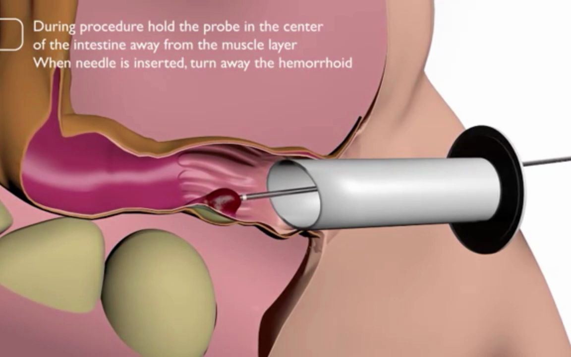 3D视频:痔疮手术,坐立不安,带入感太强了!哔哩哔哩bilibili