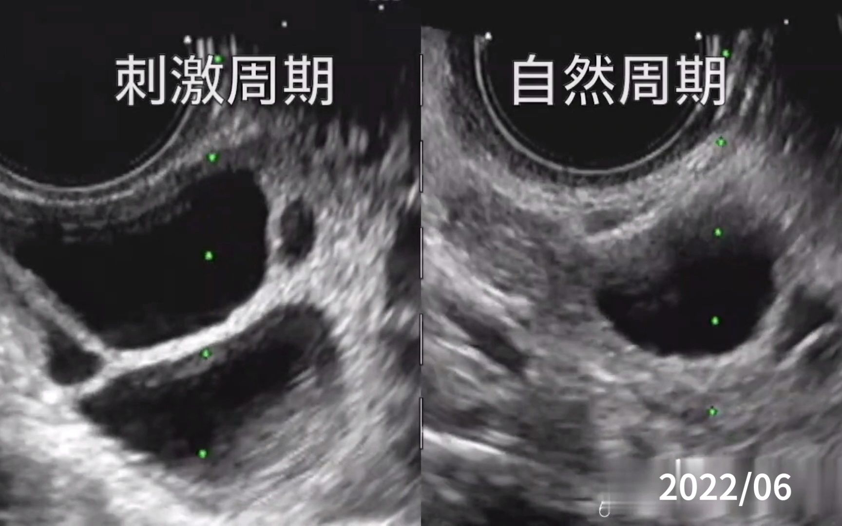 [图]B超下卵泡:刺激周期vs自然周期,取卵
